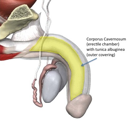 penile prosthesis insertion